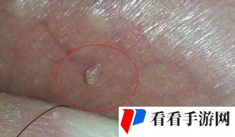 **进入**的里面长肉粒是怎么回事?